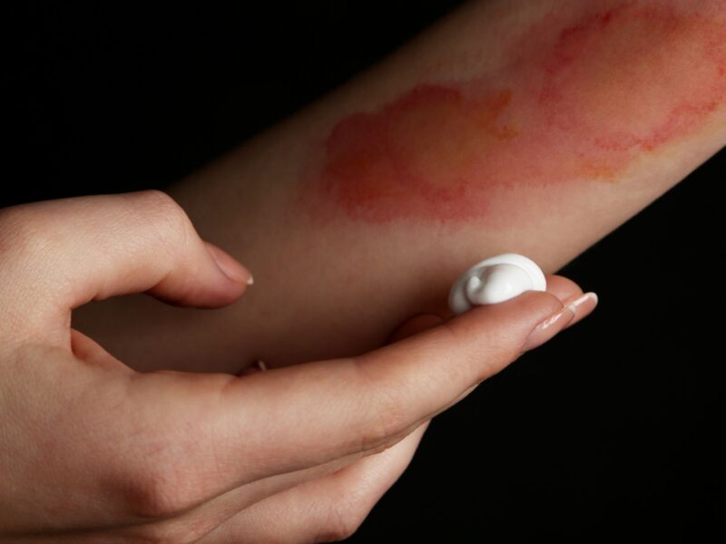 Burn Treatment: What to Expect at an Urgent Care